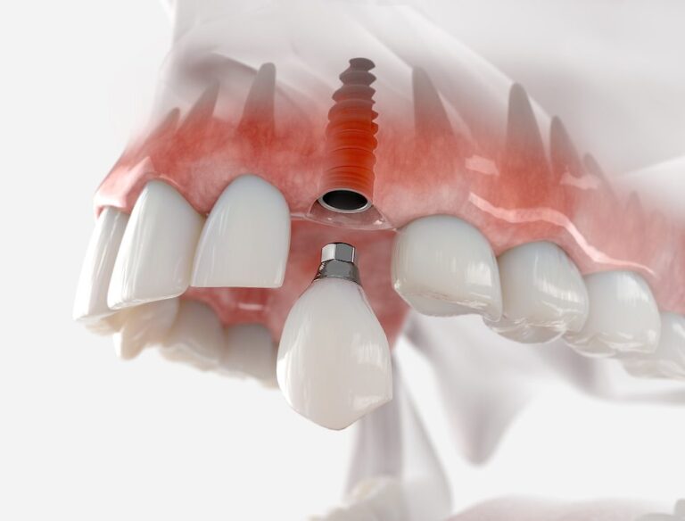 How Much Do Full Mouth Dental Implants Cost in Virginia Beach? How Much Do Full Mouth Dental Implants Cost in Virginia Beach