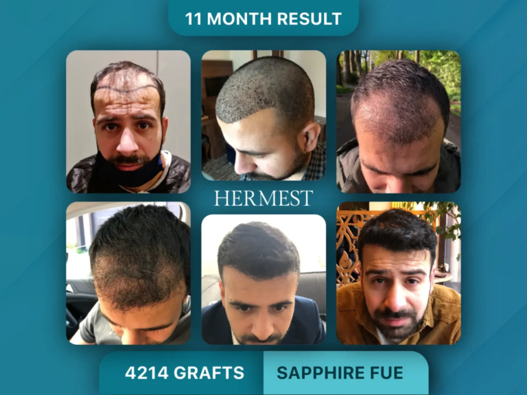 Hair Transplant in Turkey