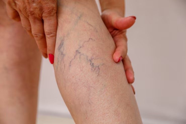 Tips for Managing Recovery Following Your Sclerotherapy in Sydney