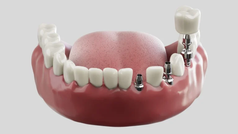 How Dental Implants Mimic Natural Tooth Roots: A Technical Deep-Dive Dental Implants Mimic Natural Tooth Roots