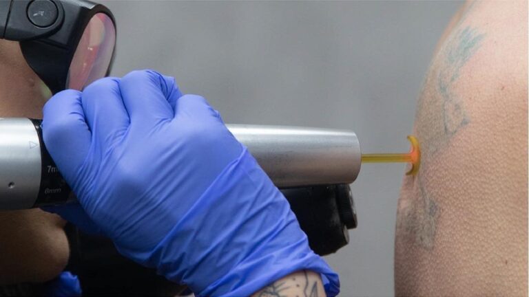 Laser vs Saline vs Surgical Tattoo Removal Compared